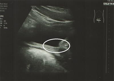 Open and Laparoscopic Colposuspension in Girls with Refractory Urinary Incontinence